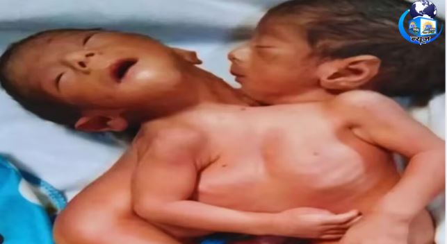 अनोखी शक्ल देख मां बनीं शॉक विक्टिम, बच्चों की लड़ाई जारी
